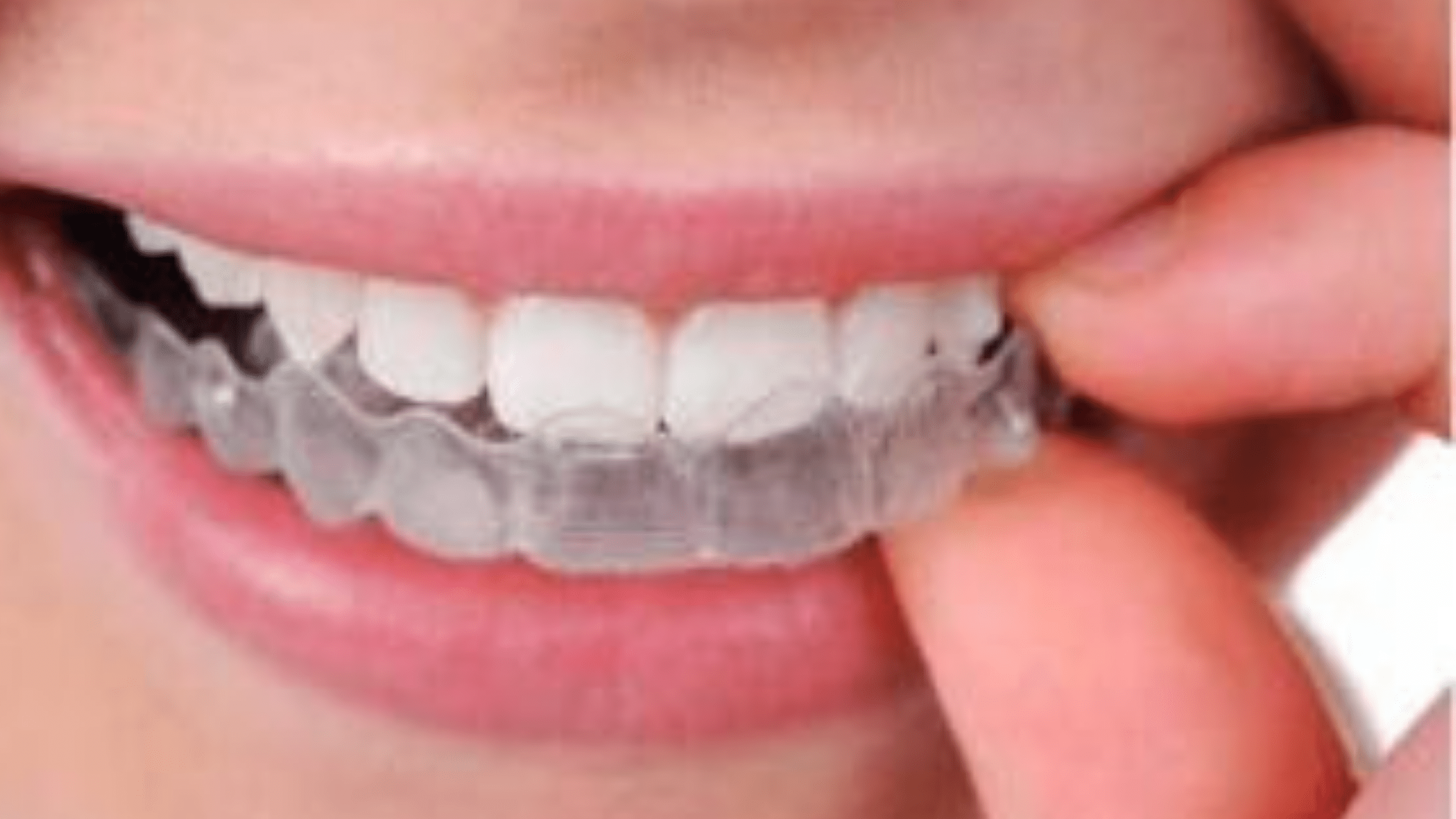 8 Amazing Benefits Of Invisalign | Tolleson Orthodontics