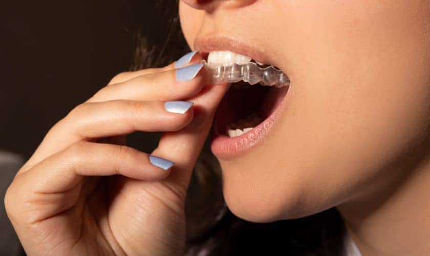 Invisalign Clear Aligners Southlake | Types & Benefits