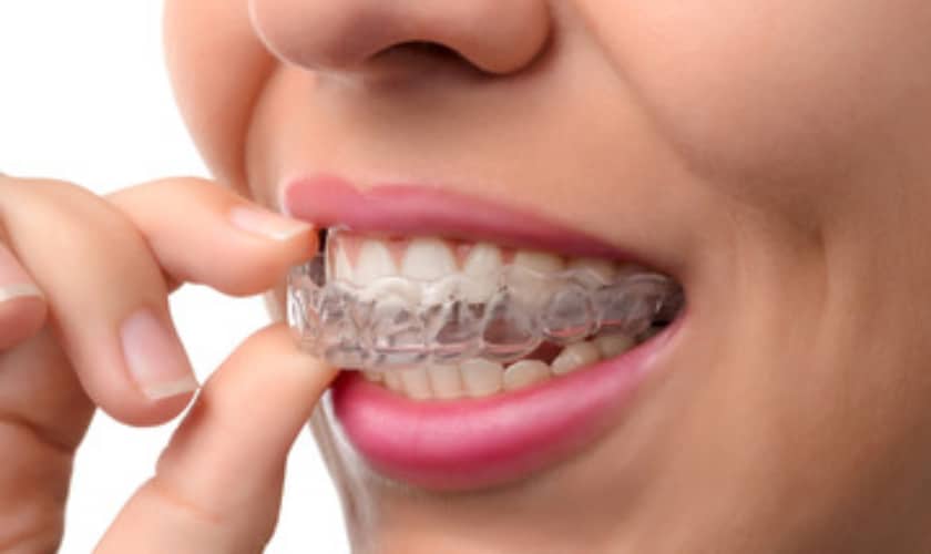 Invisalign-Treatment-Aftercare