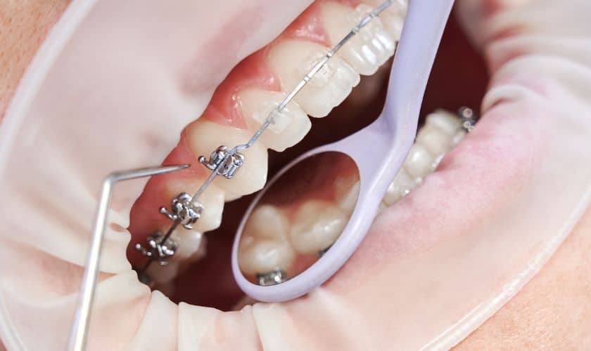 Orthodontic Treatments