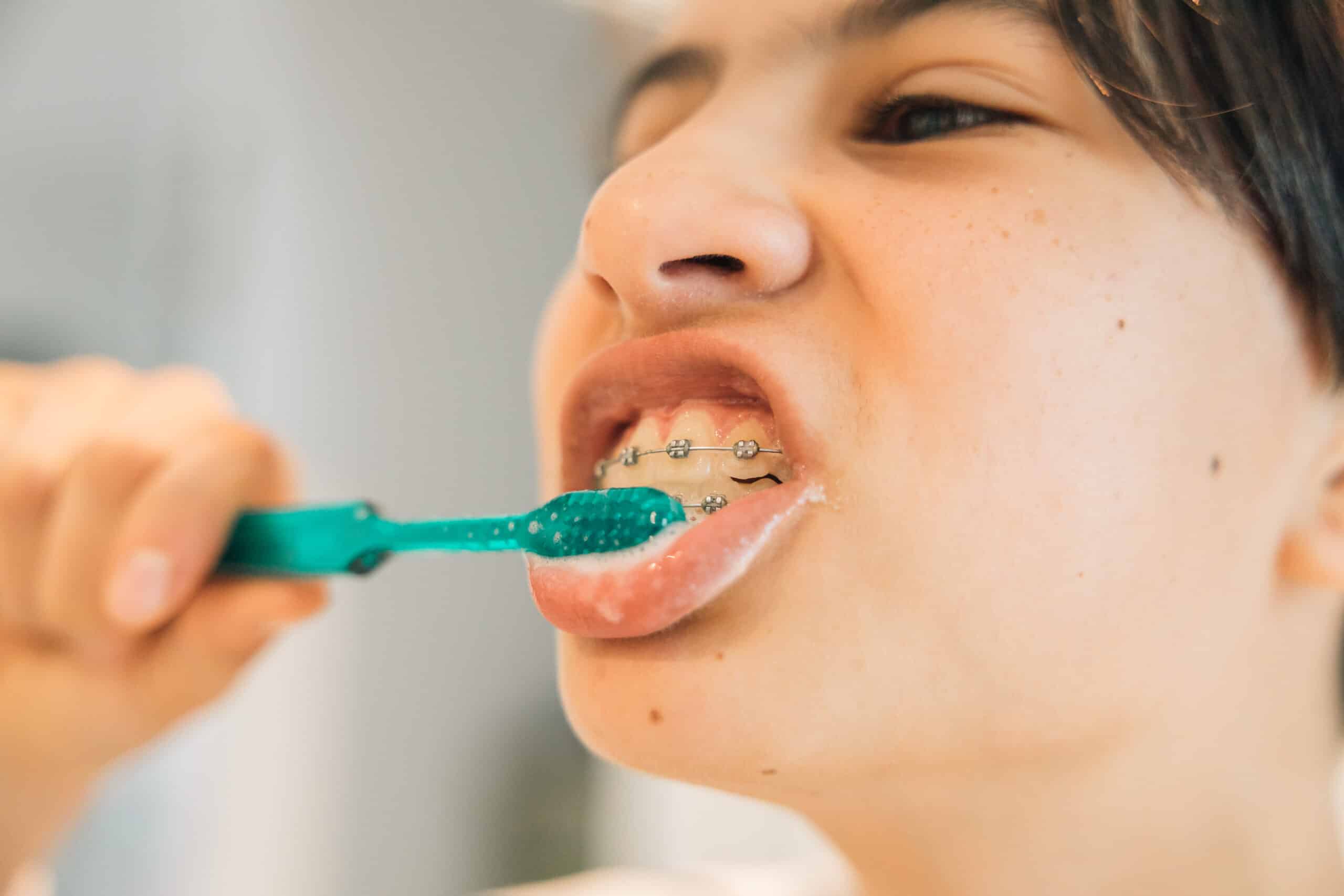 brushing with braces in southlake