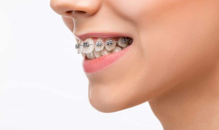 self-ligating braces