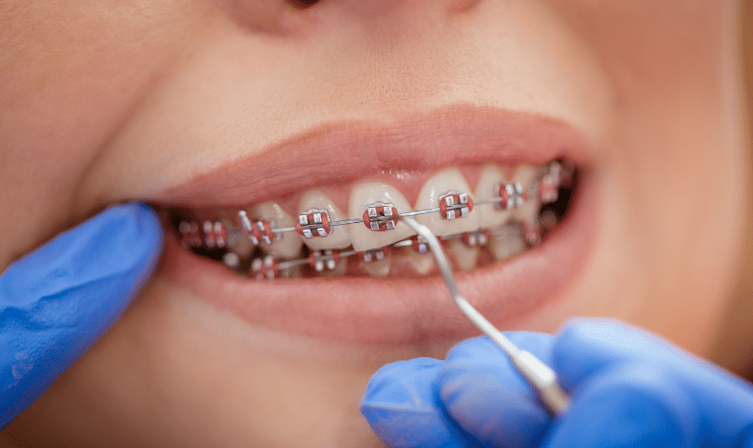 Metal Braces in Southlake-Tolleson Orthodontics