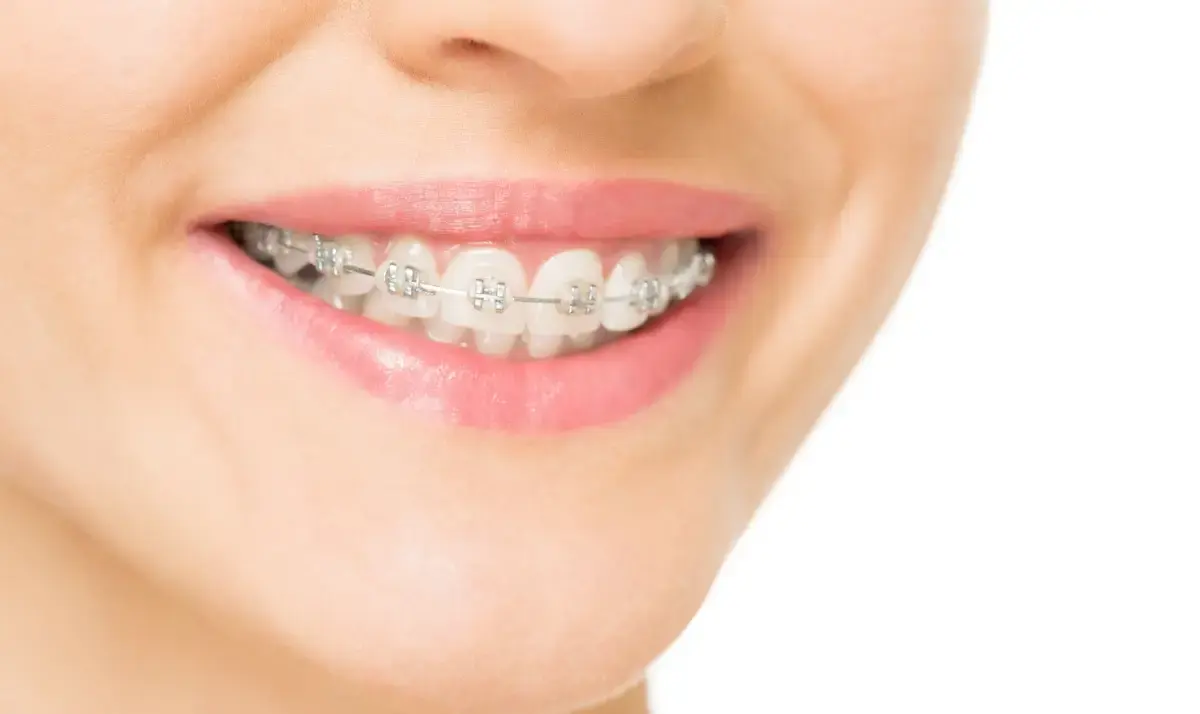 Close-up of a patient's smile showing ceramic clear braces on upper teeth.