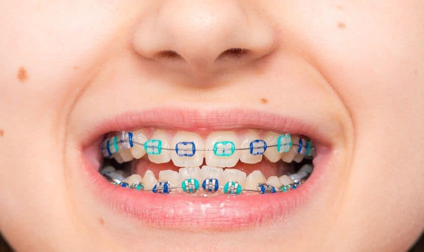 Metal Braces - Tolleson Orthodontics