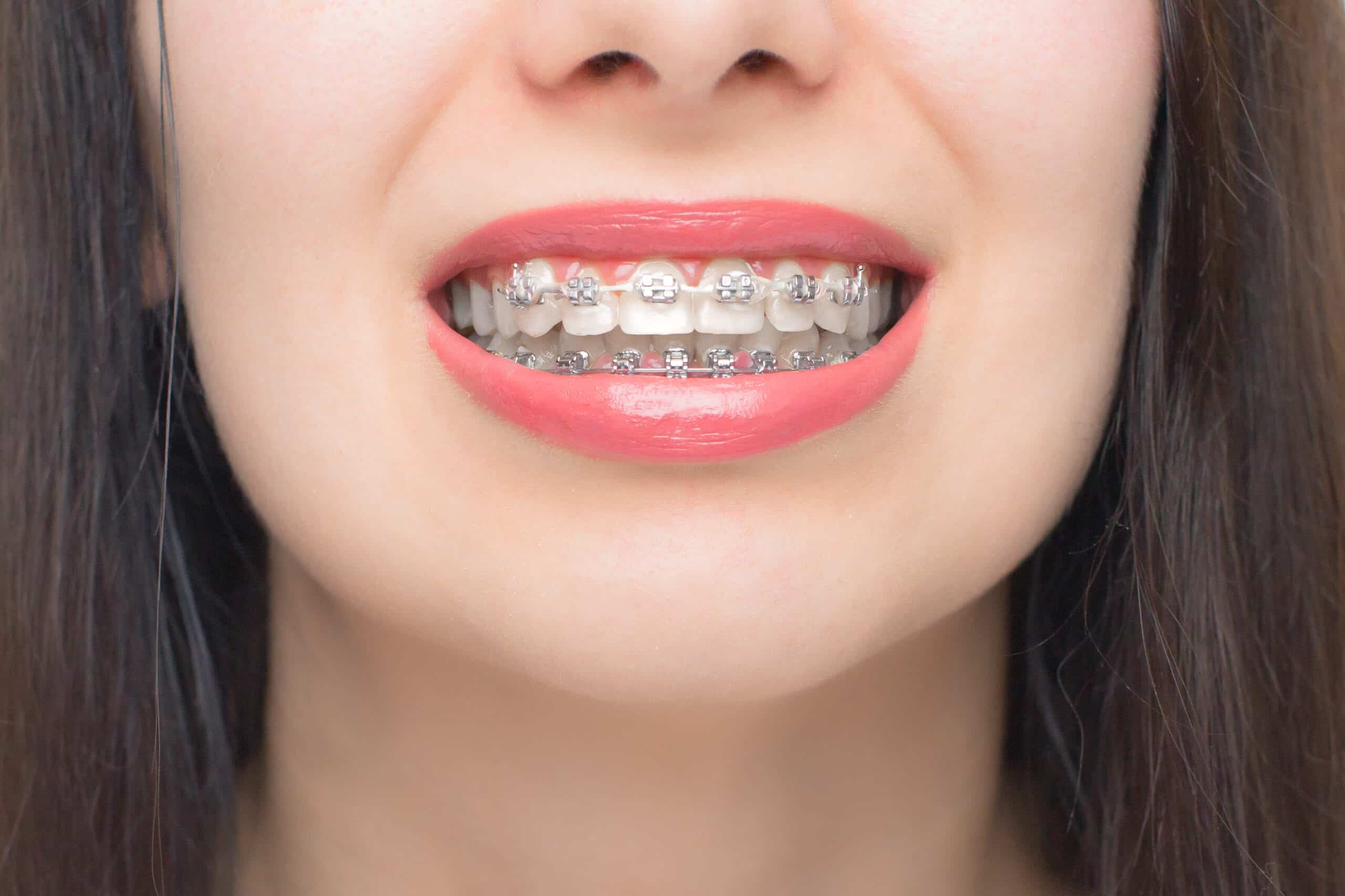 how to ease the discomfort caused by braces in southlake