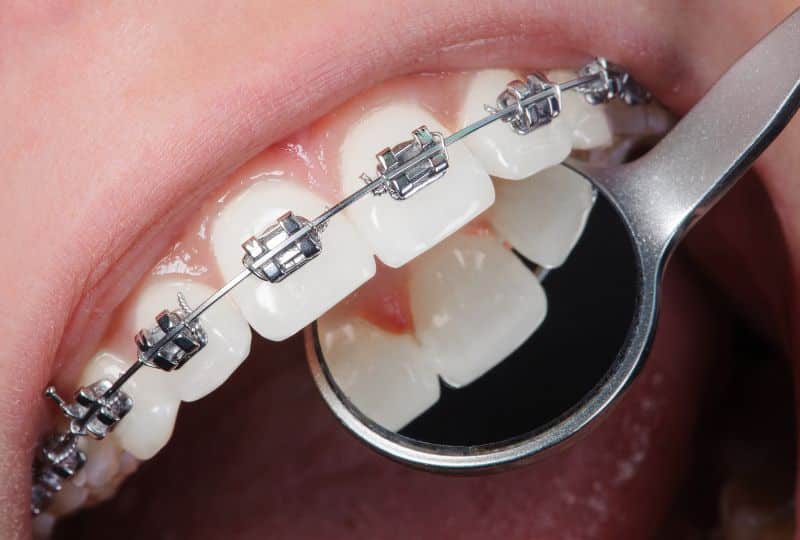 How To Handle Unexpected Orthodontic Emergencies