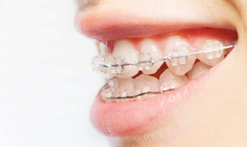 Smile In Style: A Fashionable Journey With Ceramic Braces