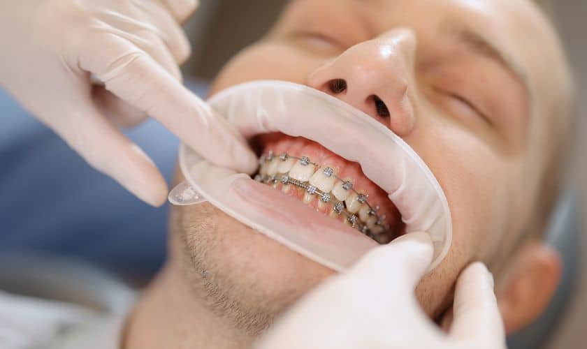 Emergency Orthodontic Solutions: Quick Fixes For Brace Issues