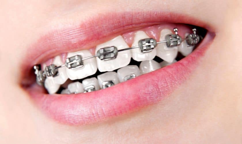 Orthodontic Elegance: Elevating Smiles With Self-Ligating Braces