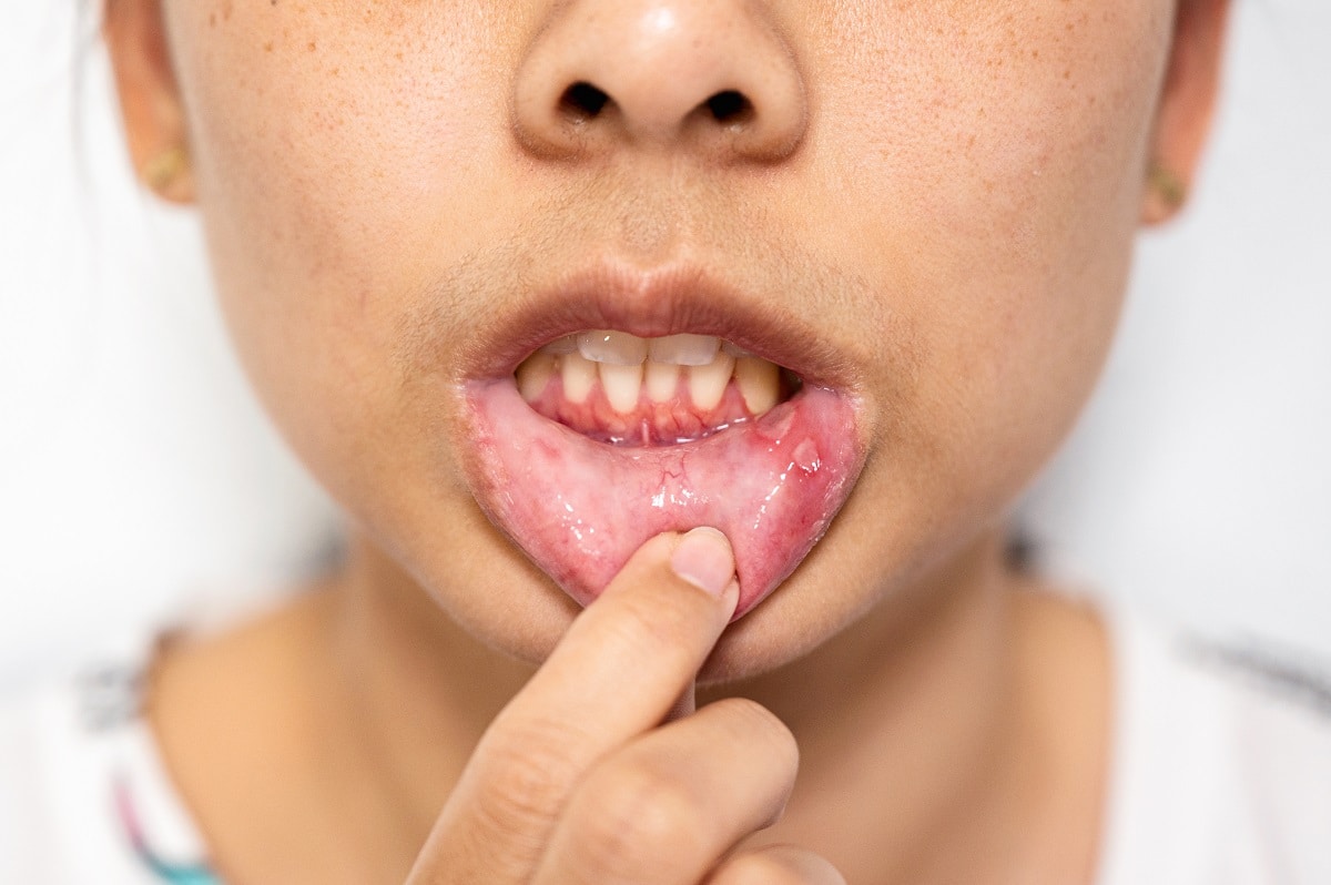 sore spots inside mouth orthodontic emergency care in southlake