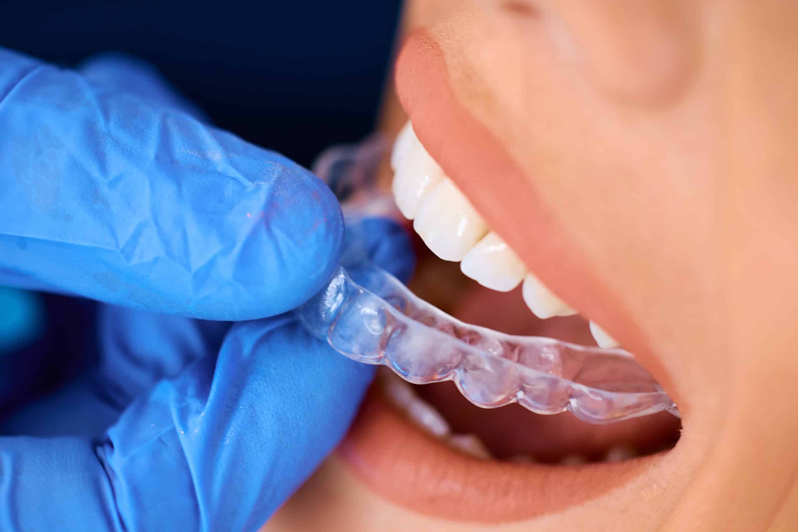 invisalign clear aligners southlake