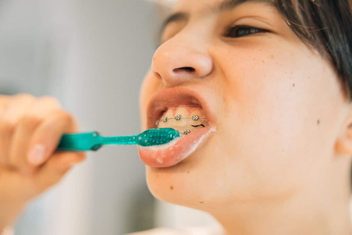 A person brushes around their braces with a toothbrush, highlighting the importance of proper oral hygiene to prevent plaque buildup and maintain healthy teeth during orthodontic care.