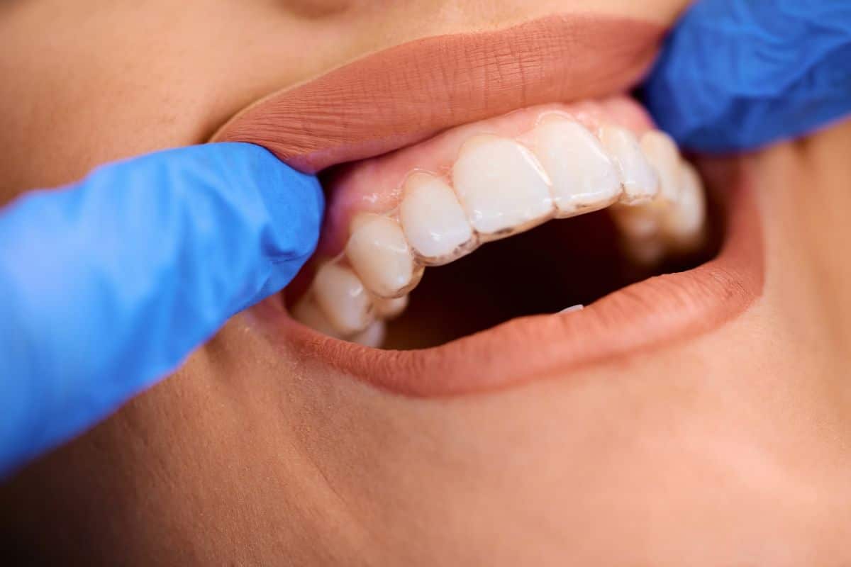 A close-up view shows clear aligners fitted over a patient’s teeth, highlighting the importance of staying on schedule with aligner changes and orthodontic checkups.