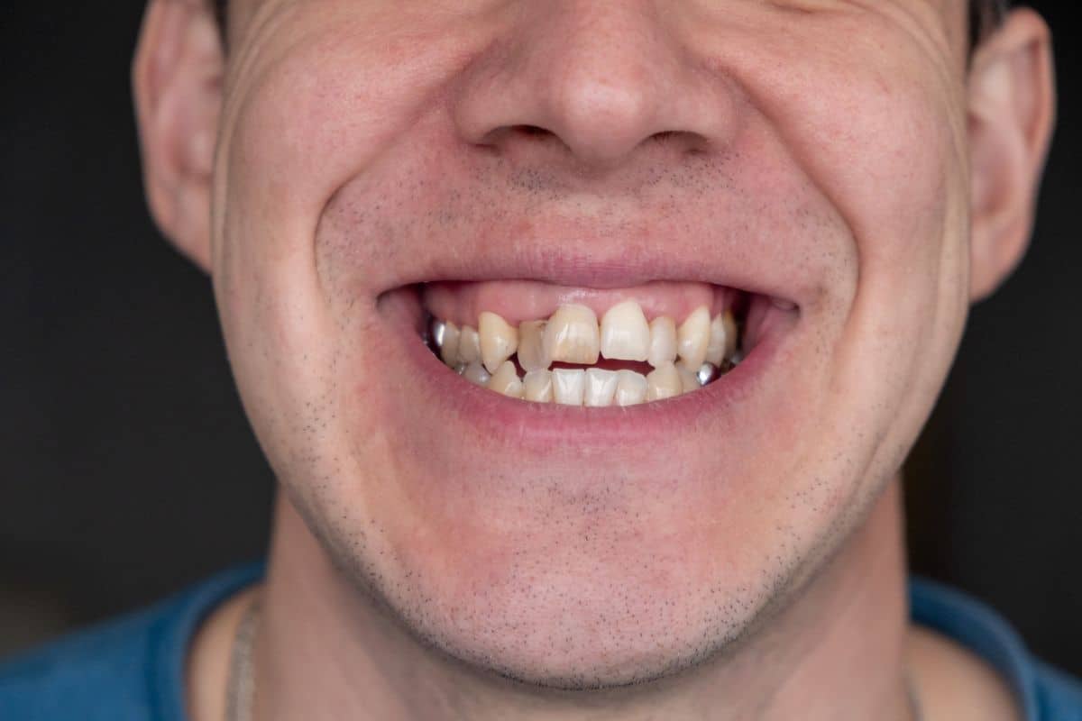 First Invisalign Digital Scan showing crowded teeth and bite alignment before Invisalign treatment