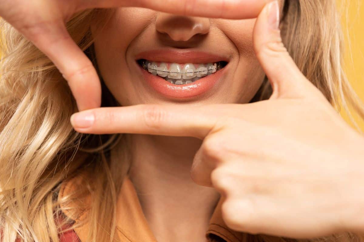 Woman wearing ceramic clear braces and smiling.